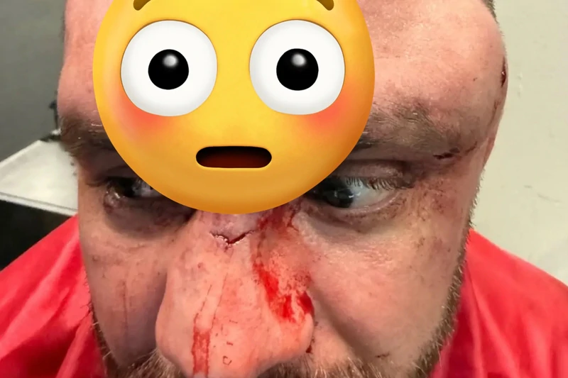 Фото: Жуткие травмы после боя на BKFC 74 — Майк Ричман показал последствия