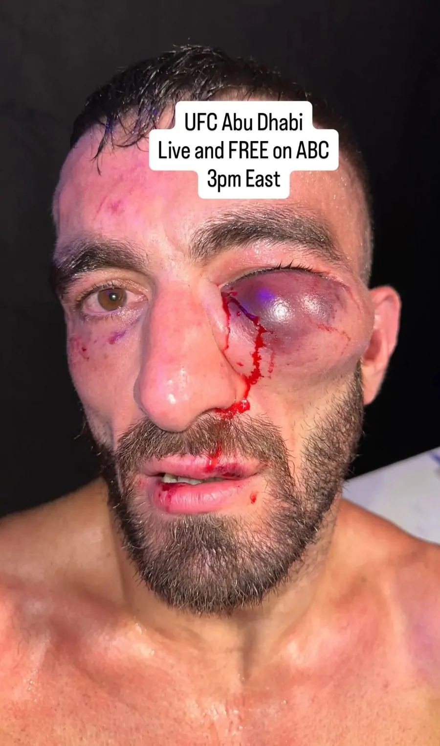 Дана Уайт показал фото травмы Мохаммада Яхьи после боя на UFC Abu Dhabi