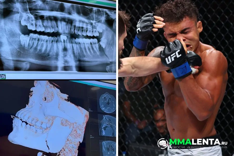 Николас Мотта показал снимки со сломанной челюстью после боя на UFC Baku